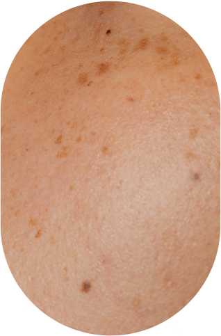 멜라닌 생성을 억제하는 레이저 프로그램