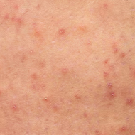 복합시술 프로토콜