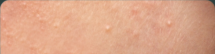 비립종 / 한관종